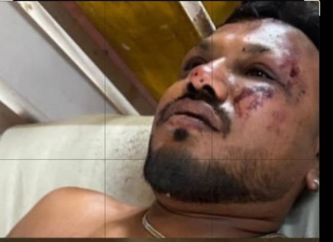 Korban selamat jatuhnya pesawat Air India, Ramesh mendapatkan perawatan di rumah sakit. [Instagram]