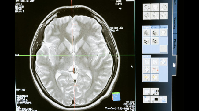 Amoeba Pemakan Otak Mengganas di India, 19 Orang Meninggal