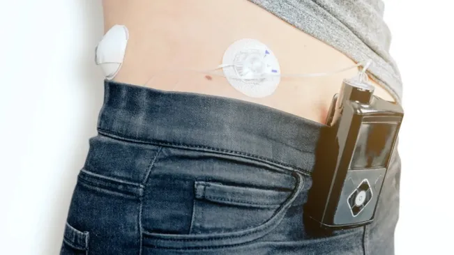 Pengidap Diabetes Kini Dapat Menggunakan Pankreas Buatan