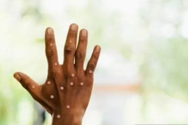 Total Mpox 27 Kasus, Tersebar di Jakarta, Tangsel dan Bandung
