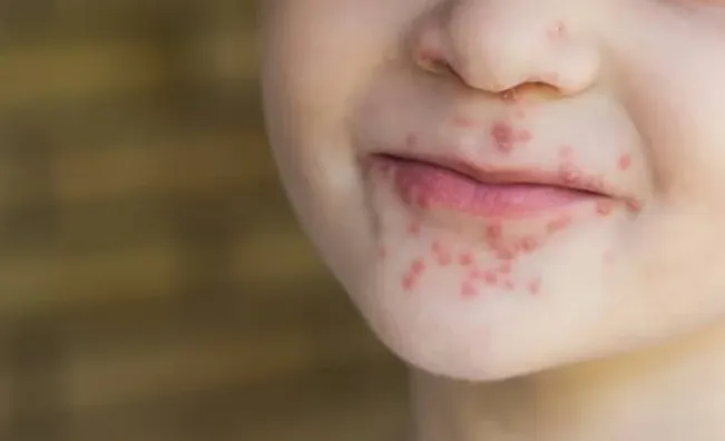 Kasus Melonjak: Cegah dan Kenali Gejala Flu Singapura