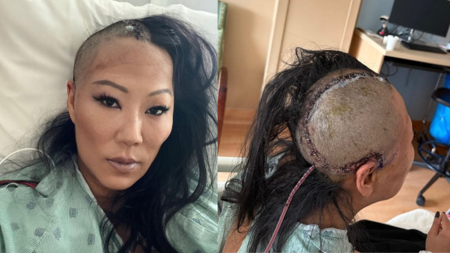 Lynn Ban, Artis Asal Singapura Meninggal Dunia Usai Operasi Otak