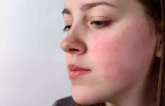Muncul Kemerahan Pada Wajah? Bisa Jadi Menderita Rosacea