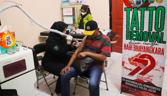 Menyambut HUT Bhayangkara, Program Hapus Tato Gratis Digelar, Siapa Mau?