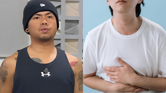 Mengenal GERD, Penyakit yang Bikin Wendy Cagur Tumbang dan Dilarikan ke RS