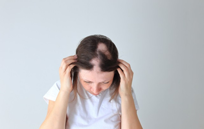 Alopecia Areata. (alodokter)