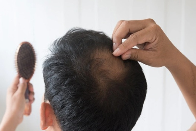 Alopecia Areata. (siloam)