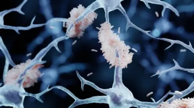 Kombinasi Stres dan Alkohol Menyebabkan Alzheimer
