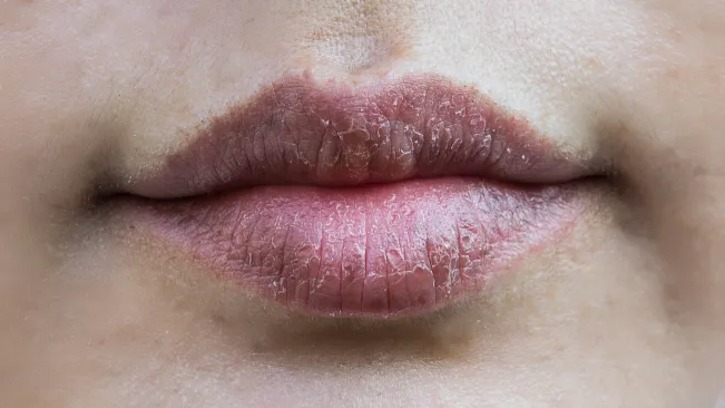 Mudah Dicari! Ini Bahan Rumahan untuk Mengatasi Bibir Kering