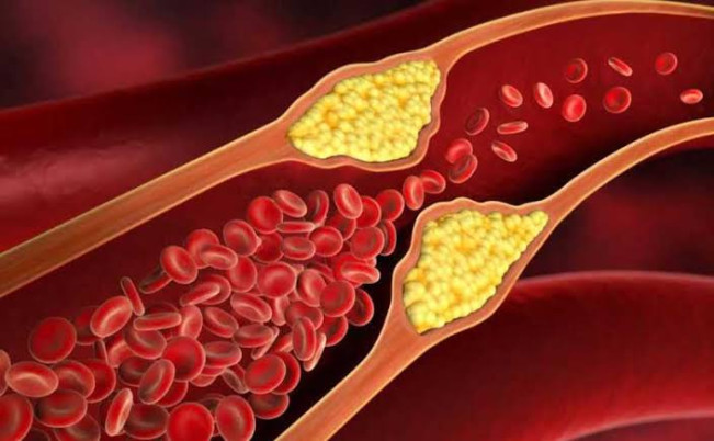 Kolesterol Tinggi Di Usia Muda, Ini Cara Atasinya
