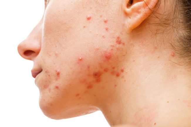 Jangan Salah, Ini Perbedaan Jerawat Hormonal dan Bakteri