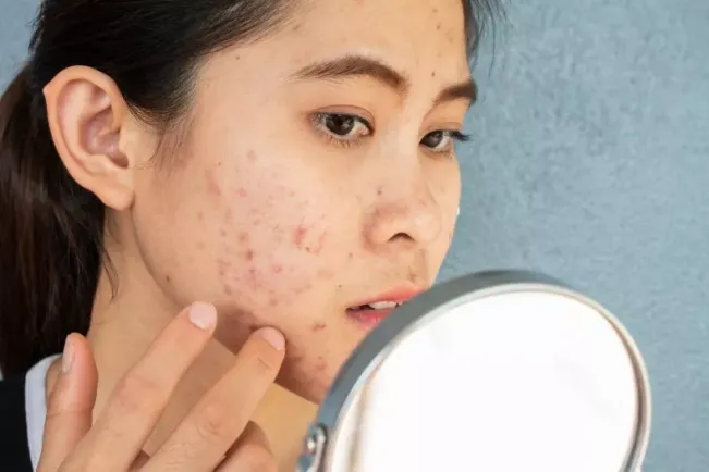 Bahaya Retinol untuk Remaja, Bisa Sebabkan Eksim