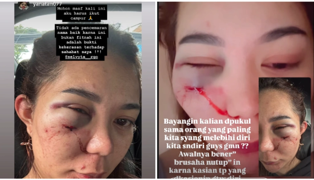 DJ Selvyta Rgo memperlihatkan kondisi wajahnya yang babak belur karena kekerasan sang pacar.