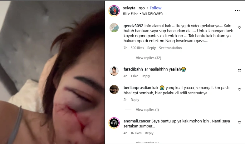 Keadaan Selvyta Rgo setelah menjadi korban penganiayaan Alentio.