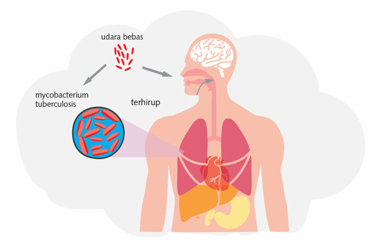 Entaskan! Kasus TBC di Indonesia Tertinggi Ketiga Dunia